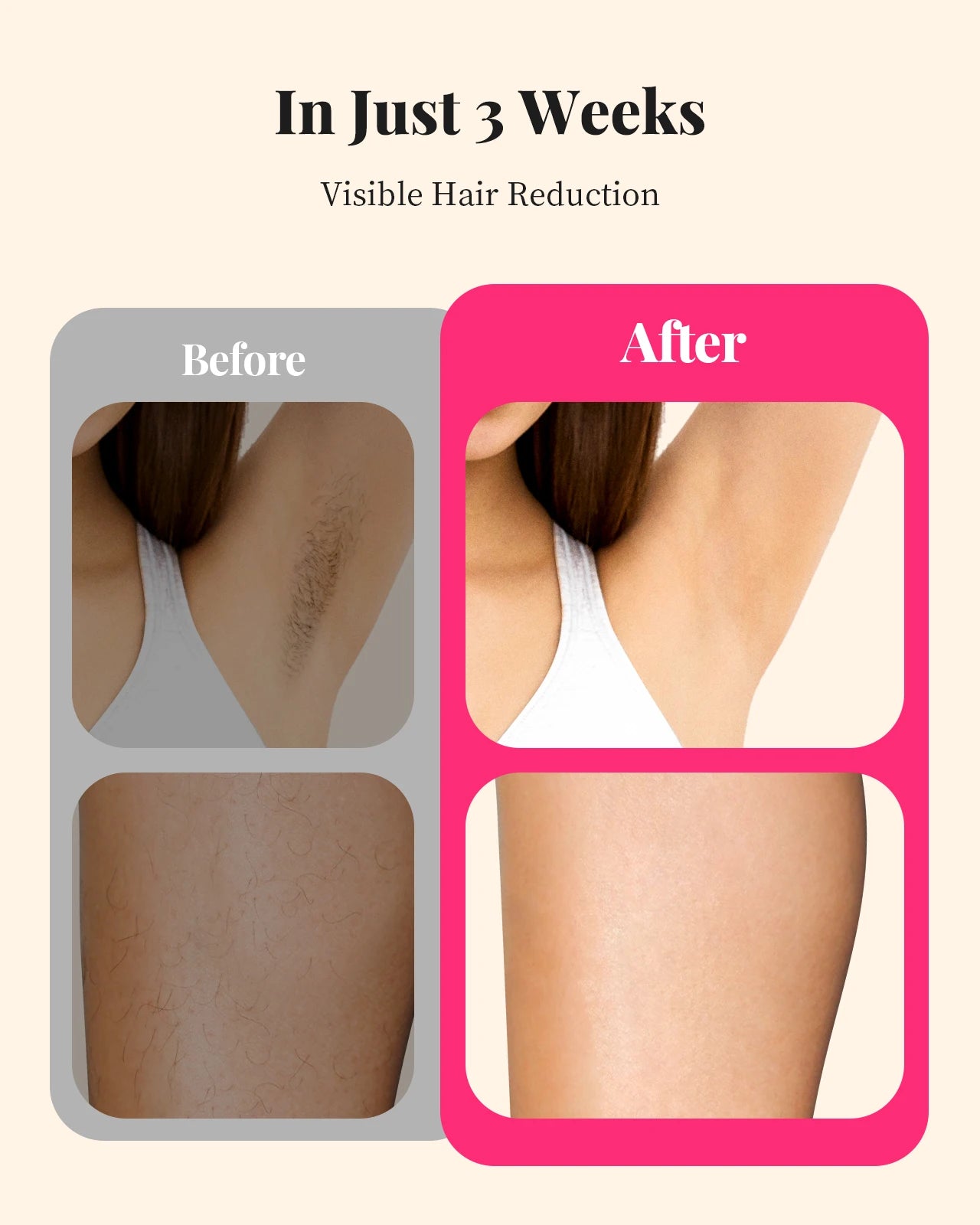 Totmizby IPL Hair Removal Device For Face Body 990000 Flashes